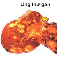 Chuyên gia lý giải vì sao ung thư gan vọt lên vị trí đầu bảng