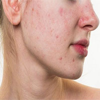 Cách xử lý khi bị dị ứng da mặt