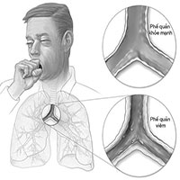 Viêm phế quản co thắt - nguyên nhân, triệu chứng và cách điều trị