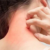 13 nguyên nhân gây ngứa khắp người càng gãi càng ngứa