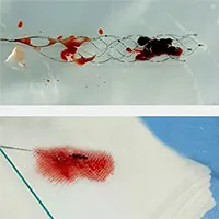 Kỹ thuật mới cứu người đột quỵ