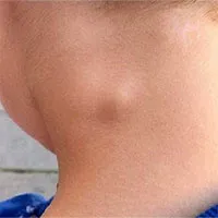 Nổi hạch ở cổ bên phải cảnh báo bệnh gì, có nguy hiểm không?