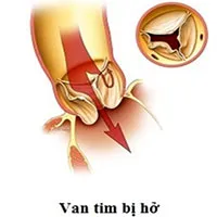 Bệnh hở van tim là gì?