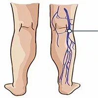 Thuyên tắc huyết khối tĩnh mạch là gì?