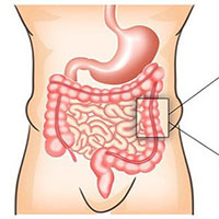 Viêm đại tràng: Nguyên nhân, triệu chứng và cách điều trị