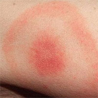 Bệnh Lyme: Nguyên nhân, triệu chứng và cách điều trị