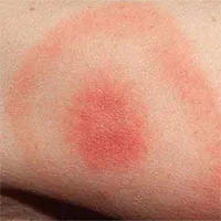 Bệnh Lyme: Nguyên nhân, triệu chứng và cách điều trị