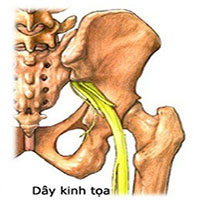 Nguyên nhân và cách điều trị đau thần kinh tọa