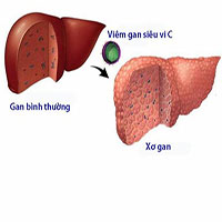 Bệnh viêm gan C: Nguyên nhân, triệu chứng và cách điều trị