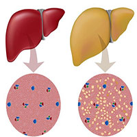 Triệu chứng và cách phòng ngừa gan nhiễm mỡ độ 2
