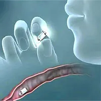 "Con nhộng" PillCam của người Do Thái: Camera nội soi ruột "tí hon", chi phí rẻ hơn nội soi thường