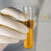 Xét nghiệm nước tiểu tại nhà phát hiện sớm ung thư tuyến tiền liệt