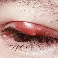 Nổi mụn ở mí mắt trên do đâu?