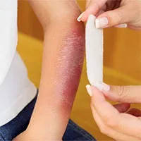 Bị bỏng kiêng ăn gì?
