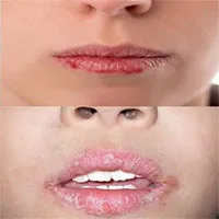 Chốc mép: Nguyên nhân, triệu chứng và cách điều trị