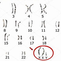 Hội chứng Klinefelter – Những người đàn ông mang gene nữ