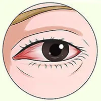 Vì sao mắt lại bị đỏ ngầu sau khi tỉnh dậy?