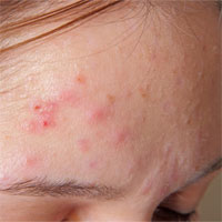 Vì sao con người bị mụn trứng cá?