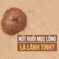 Lông mọc ở nốt ruồi không gây ung thư và có thể cắt bỏ được: Sự thật có phải vậy không?