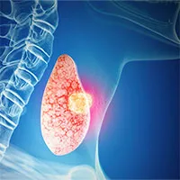 Những định kiến sai lầm về bệnh ung thư