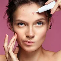 6 lầm tưởng về nguyên nhân gây ra mụn