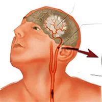 Bệnh rối loạn tuần hoàn não: Nguyên nhân, triệu chứng và cách điều trị