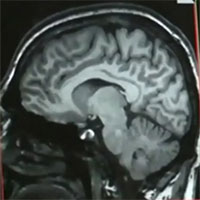 Căn bệnh bí ẩn gây chết người tại Canada