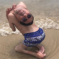 Chứng bệnh kỳ quái khiến người mắc bị lộn ngược đầu