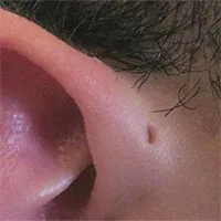 Rò luân nhĩ: Nguyên nhân, triệu chứng và cách điều trị