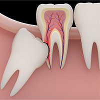 Biến chứng nguy hiểm khi răng khôn mọc ngầm