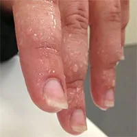 Căn bệnh khiến người mắc đổ nhiều mồ hôi