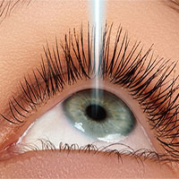 Những nguyên nhân gây tái cận sau mổ mắt