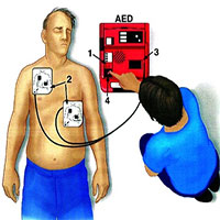 Máy khử rung tim ngoài là gì?