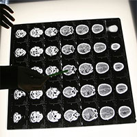 Người đàn ông mất cảm giác sợ hãi sau khi phẫu thuật não