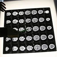 Người đàn ông mất cảm giác sợ hãi sau khi phẫu thuật não
