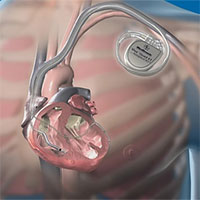 Máy ICD trong cơ thể Christian Eriksen hoạt động ra sao?