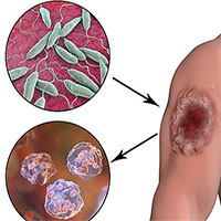 Ký sinh trùng ăn thịt hoành hành ở châu Mỹ