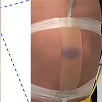 Phát triển thành công da nhân tạo có thể bầm tím như thật