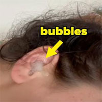 Trào lưu đổ oxy già vào tai tiềm ẩn nguy hiểm trên TikTok