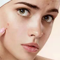 Nghiện nặn mụn: Sở thích kỳ lạ hay hội chứng bệnh?
