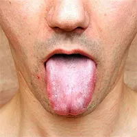 Bệnh giang mai là gì?