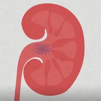 Video: Sỏi thận hình thành như thế nào?