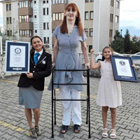 Căn bệnh khiến cô gái Tây Ban Nha cao hơn 2m