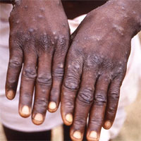 CDC Mỹ xác nhận ca nhiễm bệnh đậu mùa khỉ tại bang Maryland