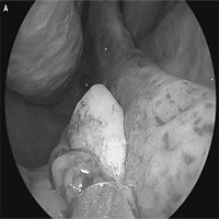 Khó thở nhiều năm, người đàn ông đi khám thì phát hiện vật kỳ lạ này mọc ngay trong mũi