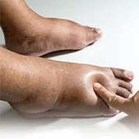 Bệnh chân voi: Nguyên nhân, triệu chứng và cách điều trị