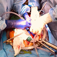 Lần đầu tiên thành công cấy ghép thận heo cho người chết não