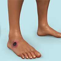 Độc tố bệnh than có thể là chìa khóa cho các liệu pháp giảm đau mới