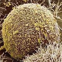 Người phụ nữ đầu tiên trên thế giới khỏi HIV nhờ liệu pháp cấy tế bào gốc