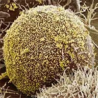 Người phụ nữ đầu tiên trên thế giới khỏi HIV nhờ liệu pháp cấy tế bào gốc